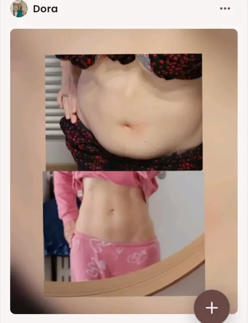Before-and-after post-pregnancy photo of Dora, who lost 10kg with Pilates Linfodrenante