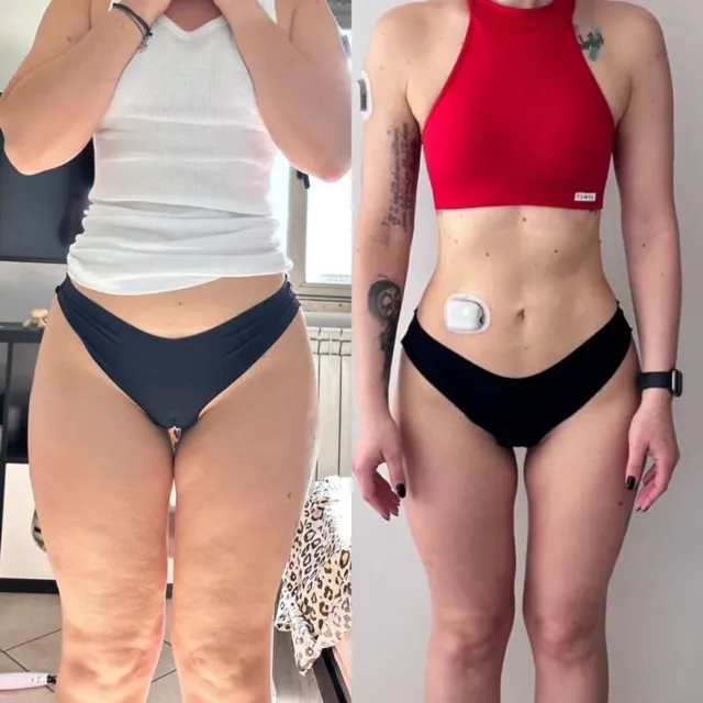 Before-and-after photo of Roberta after 1 year of Pilates Linfodrenante